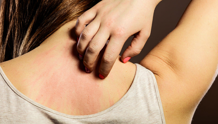 urticaria-por-estres urticaria-por-estres